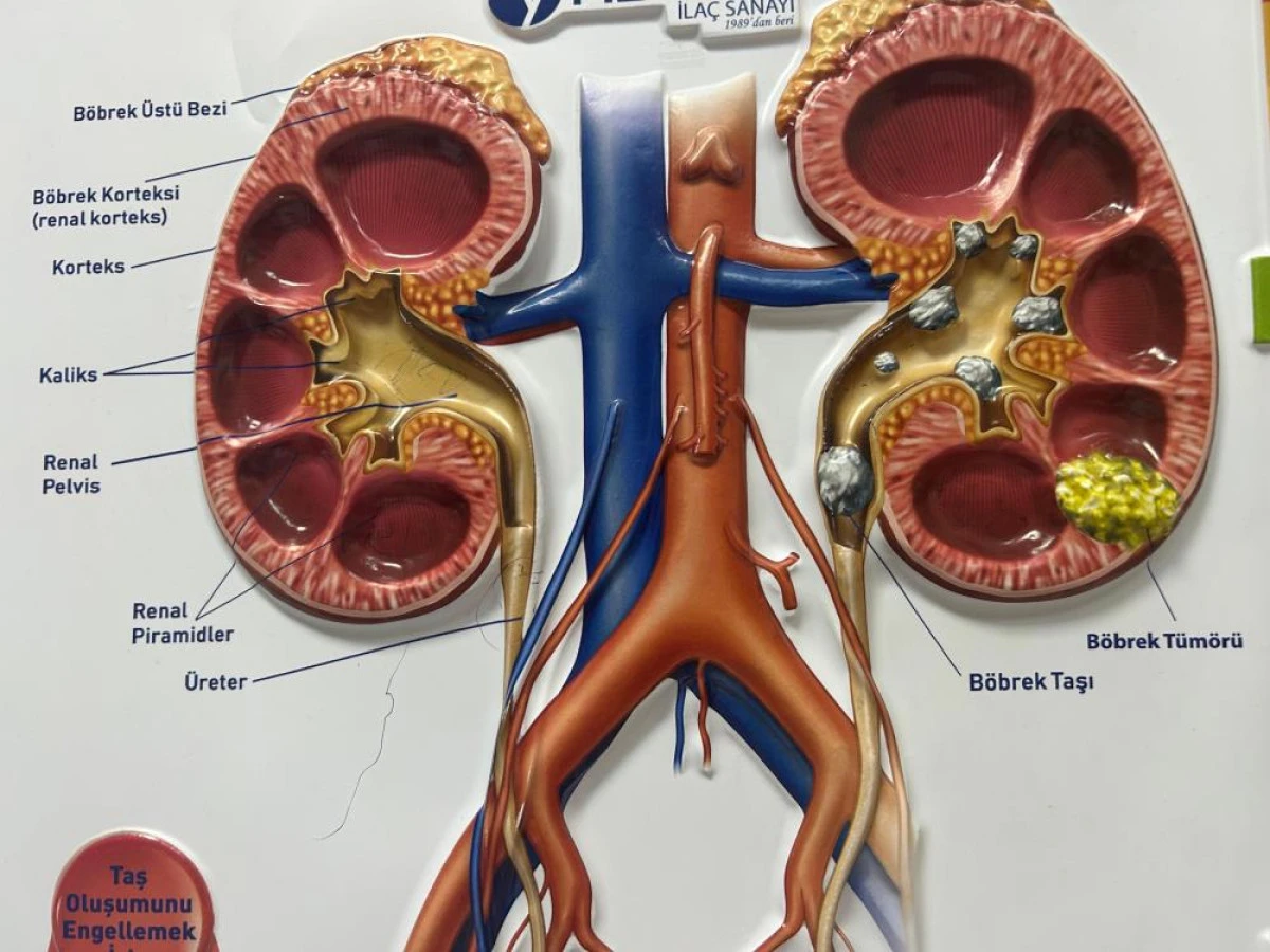 &Uuml;roloji Uzmanı Dr. Şığva: "Taş hastalığı b&ouml;brek kaybına yol a&ccedil;ıyor"
